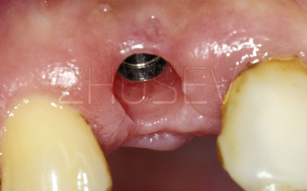Healing caps Prosthetic procedure