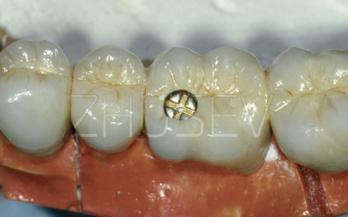 Occlusal screwretained crowns Prosthetic procedure